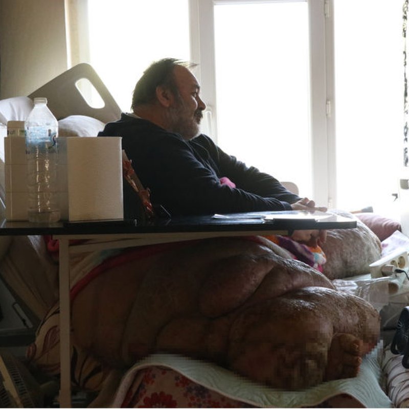 Beş yıldır evden dışarı çıkamayan fil hastası, eşiyle birlikte caddede yürümeyi hayal ediyor.