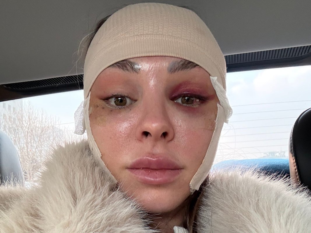 I traveled from the US to South Korea to get a facelift at 34. It boosted my confidence.
