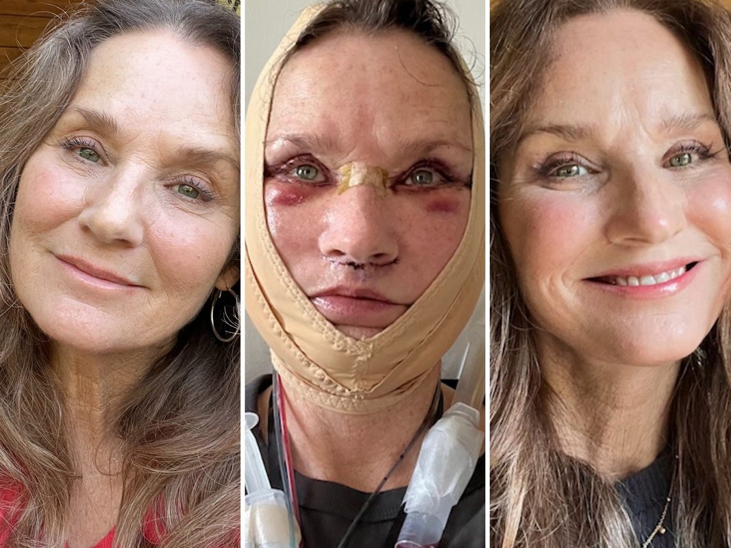 Against people's advice, I traveled to Mexico for a facelift. They: assumed it was risky, but it turned out to be great.