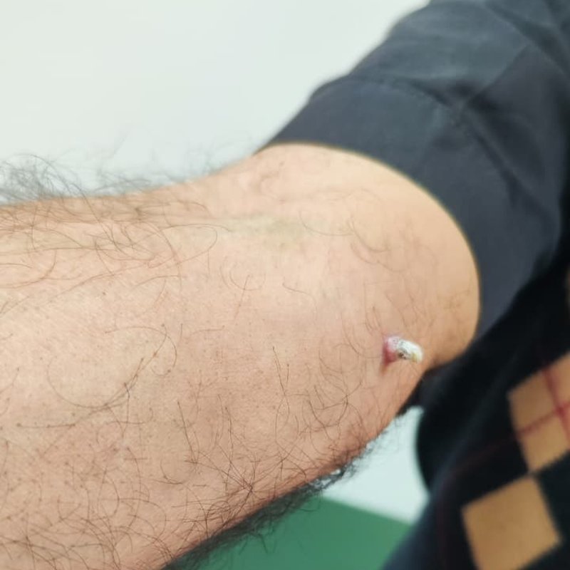 Kolundaki yara için: gitti, kanser olduğunu öğrendi
