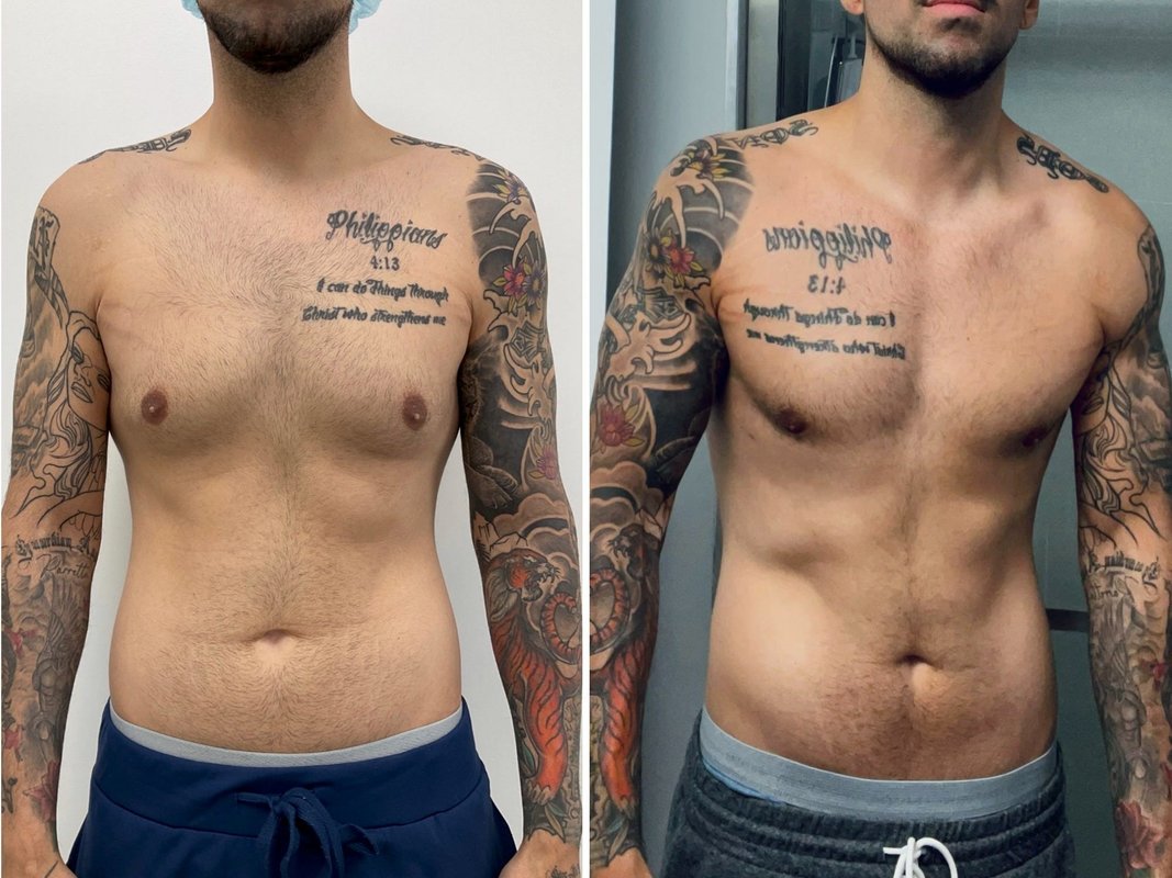 Men get cosmetic surgery, too. I spent $14,000: on plastic surgery, and I don't regret it.