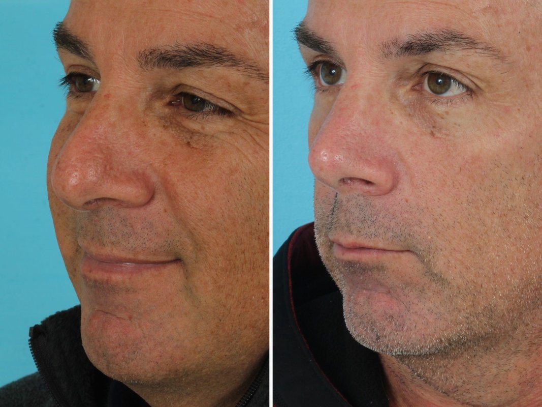I'm a retired firefighter. I spent $14,000 on: plastic surgery in my 50s, and I'm not ashamed.