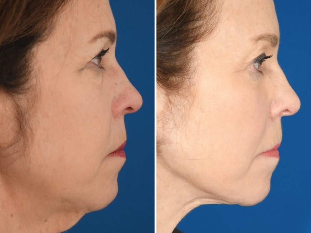 I've spent $33,000 on cosmetic procedures at 65.: It's been life-changing for my career and confidence.